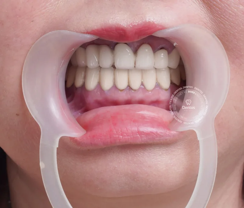 Bọc răng sứ bị đen viền nướu? 4 nguyên nhân chính và cách khắc phục